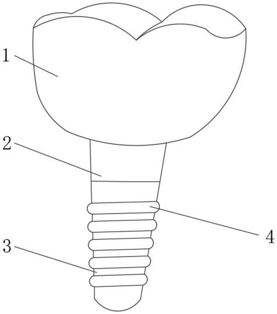 A kind of bioactive glass dental implant and preparation method thereof