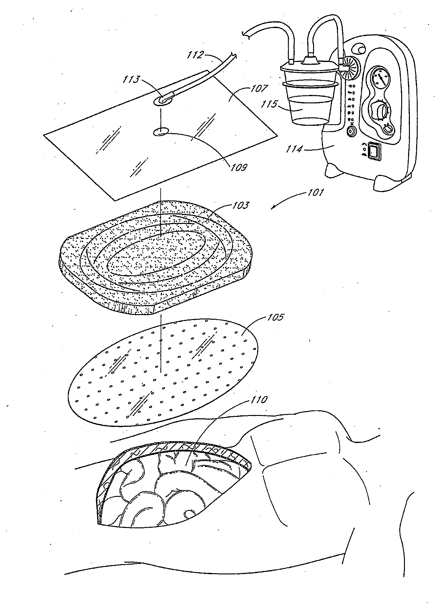 Bespoke wound treatment apparatuses and methods for use in negative pressure wound therapy