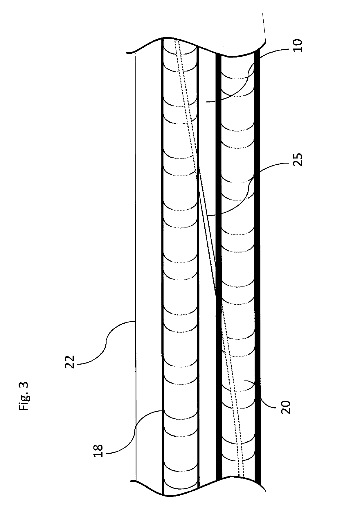 Externally supported anastomosis