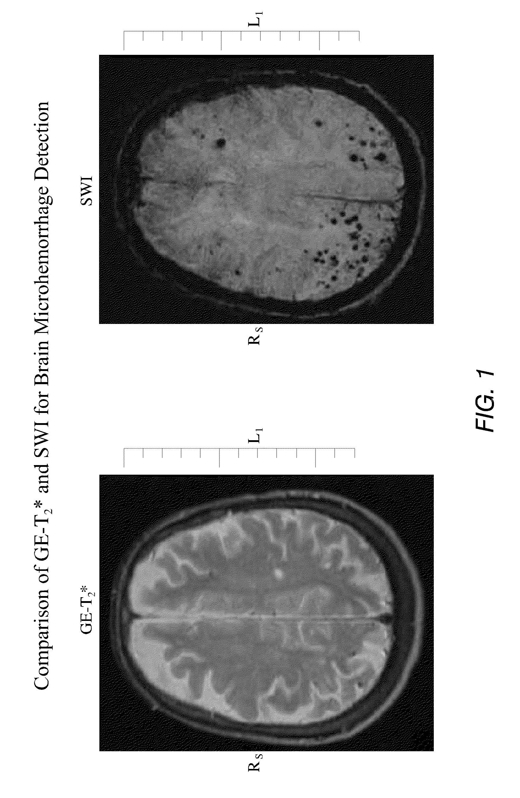 Inhibition of brain enzymes involved in cerebral amyloid angiopathy and macular degeneration