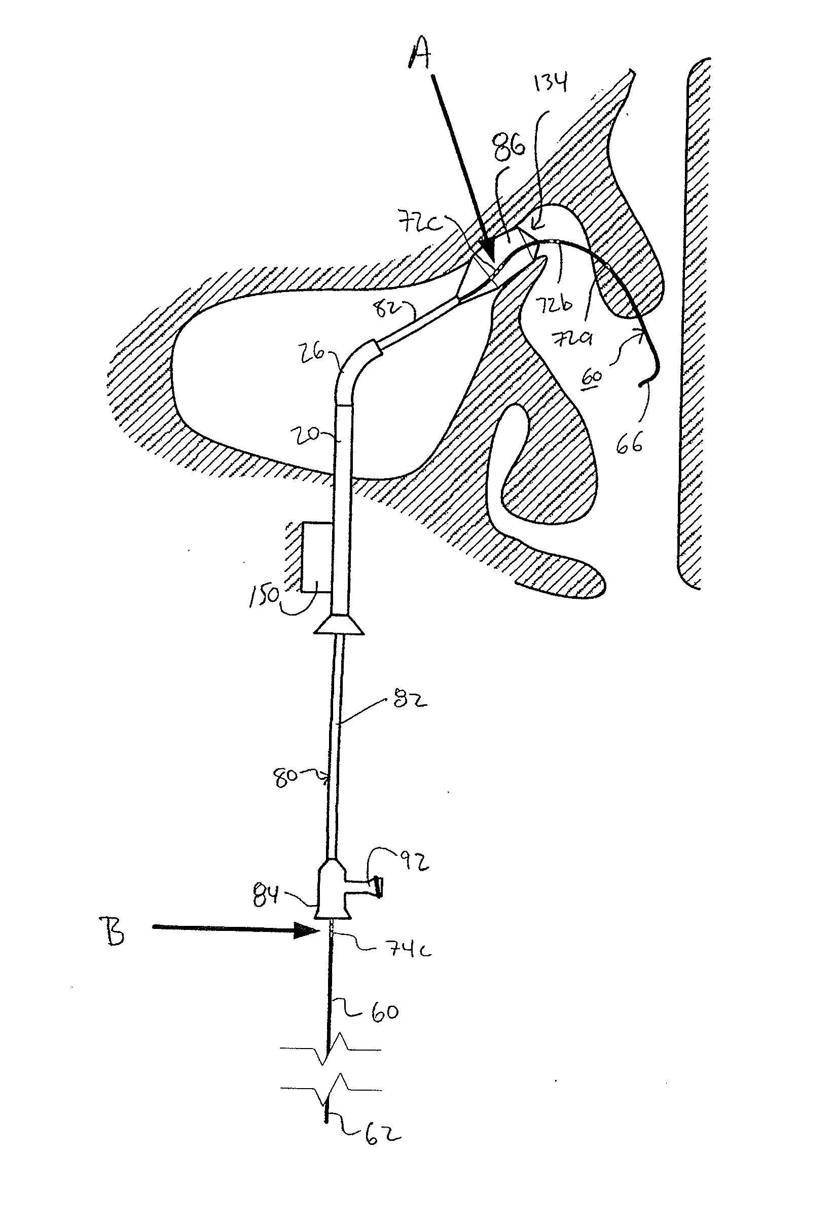 Apparatus and method for treatment of sinusitis