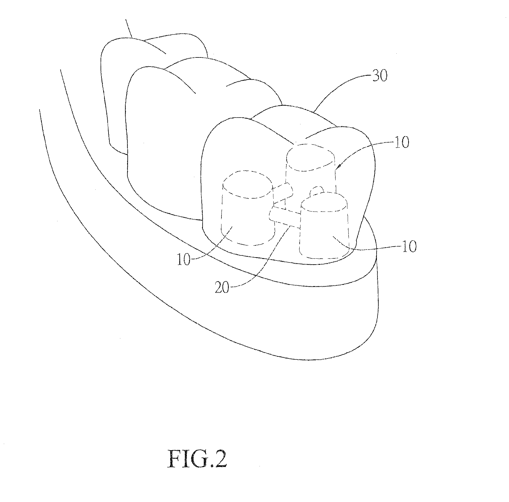 Artificial tooth with multiple internal crowns