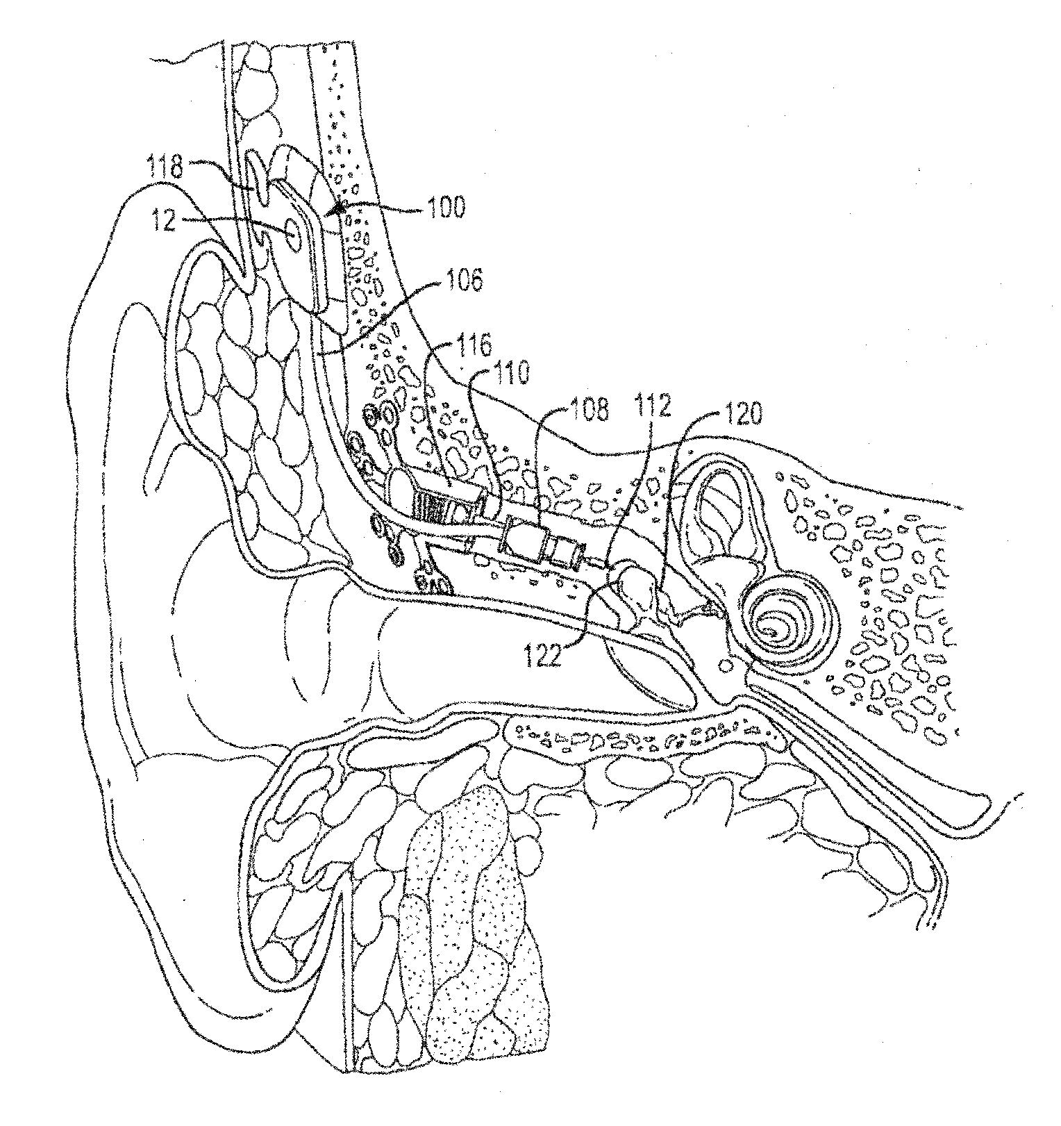 Adaptive Cancellation System For Implantable Hearing Instruments