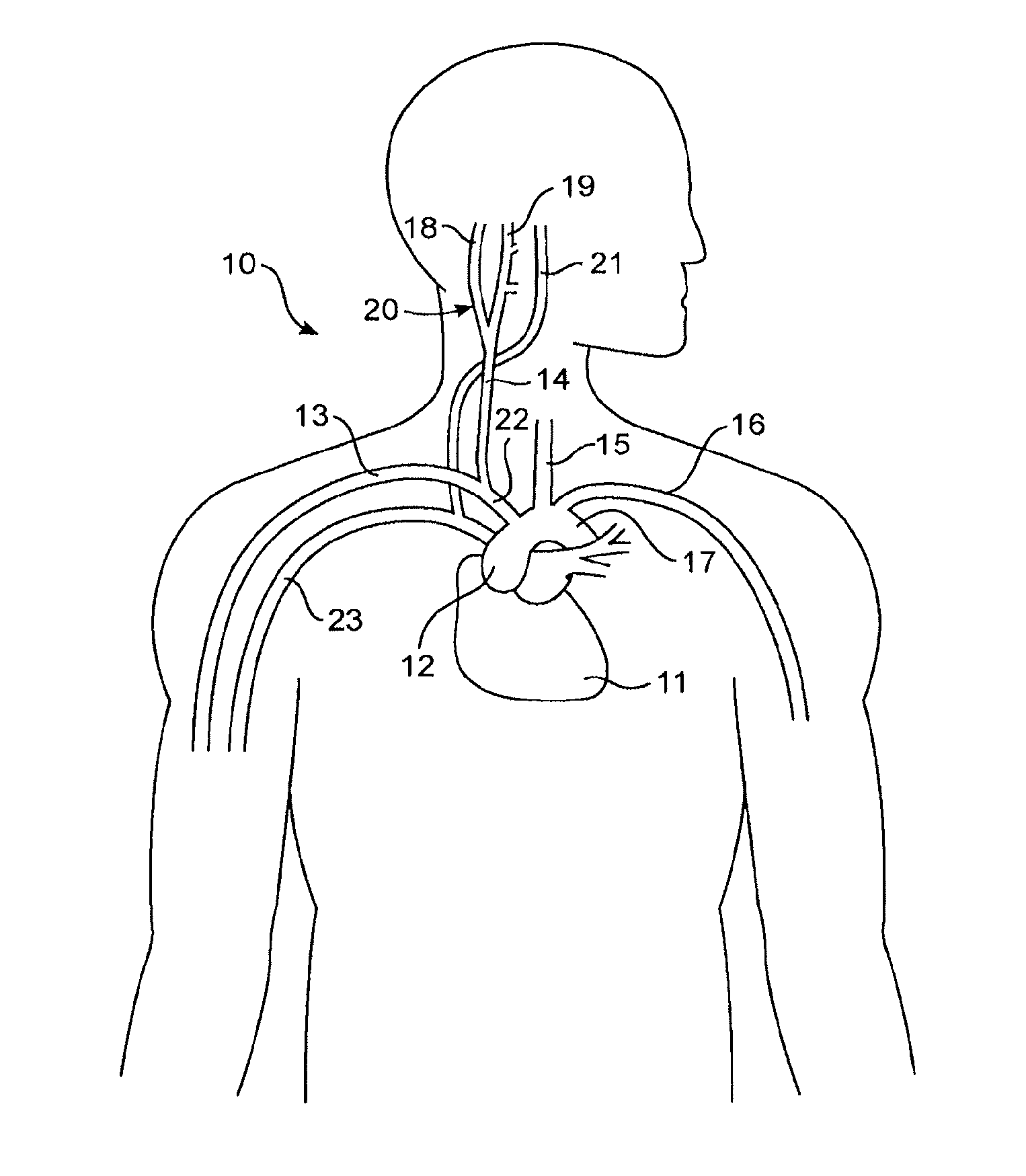 ECG input to implantable pulse generator using carotid sinus leads