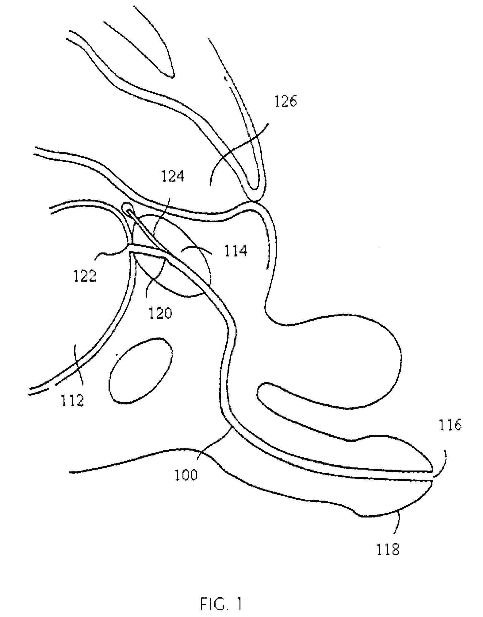 Device for local ablation of tissue