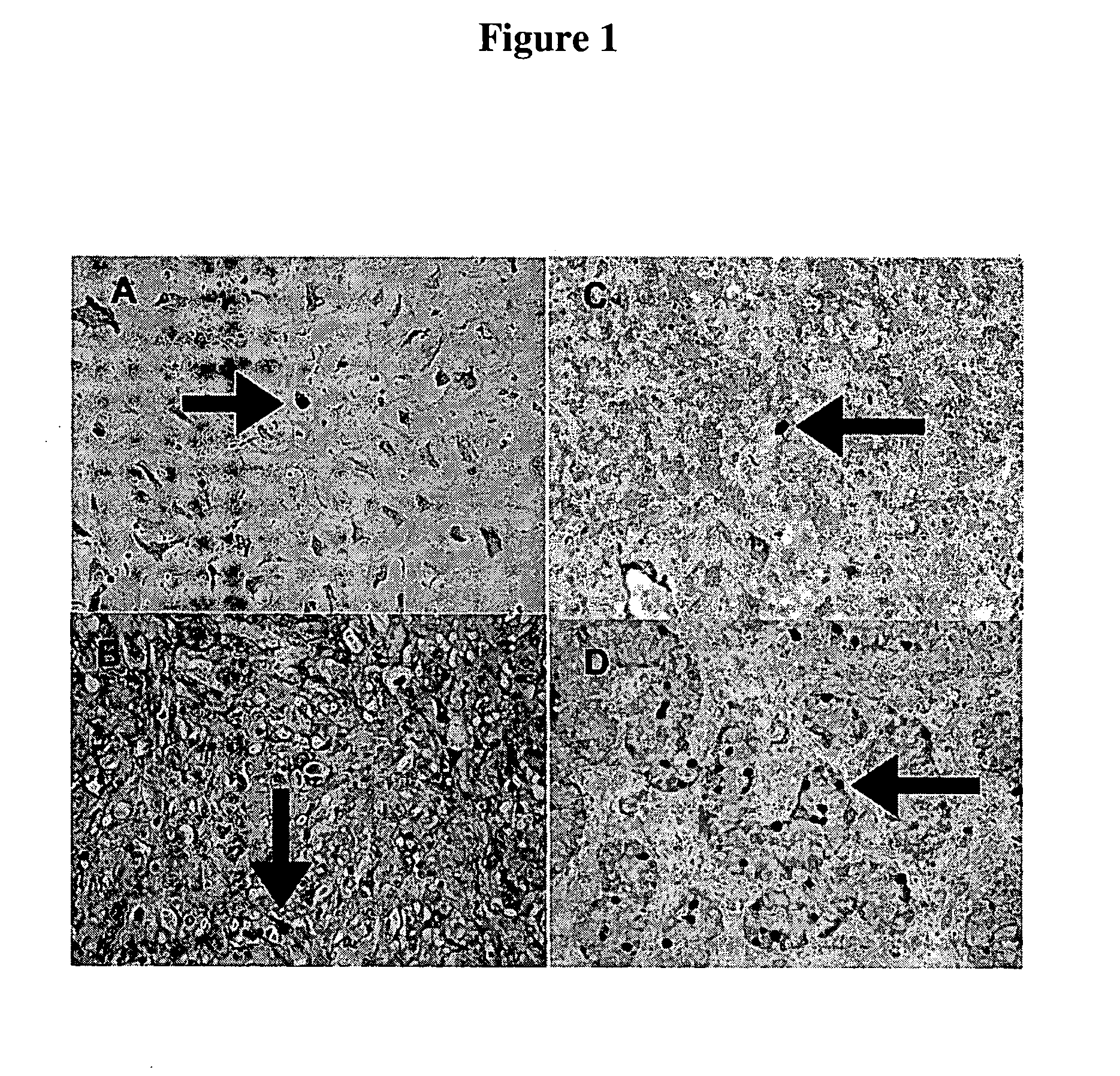 Compositions enriched in neoplastic stem cells and methods comprising same