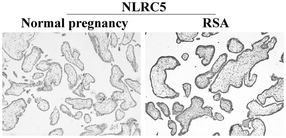 Diagnostic kit for recurrent spontaneous abortion and application of NLRC5 gene