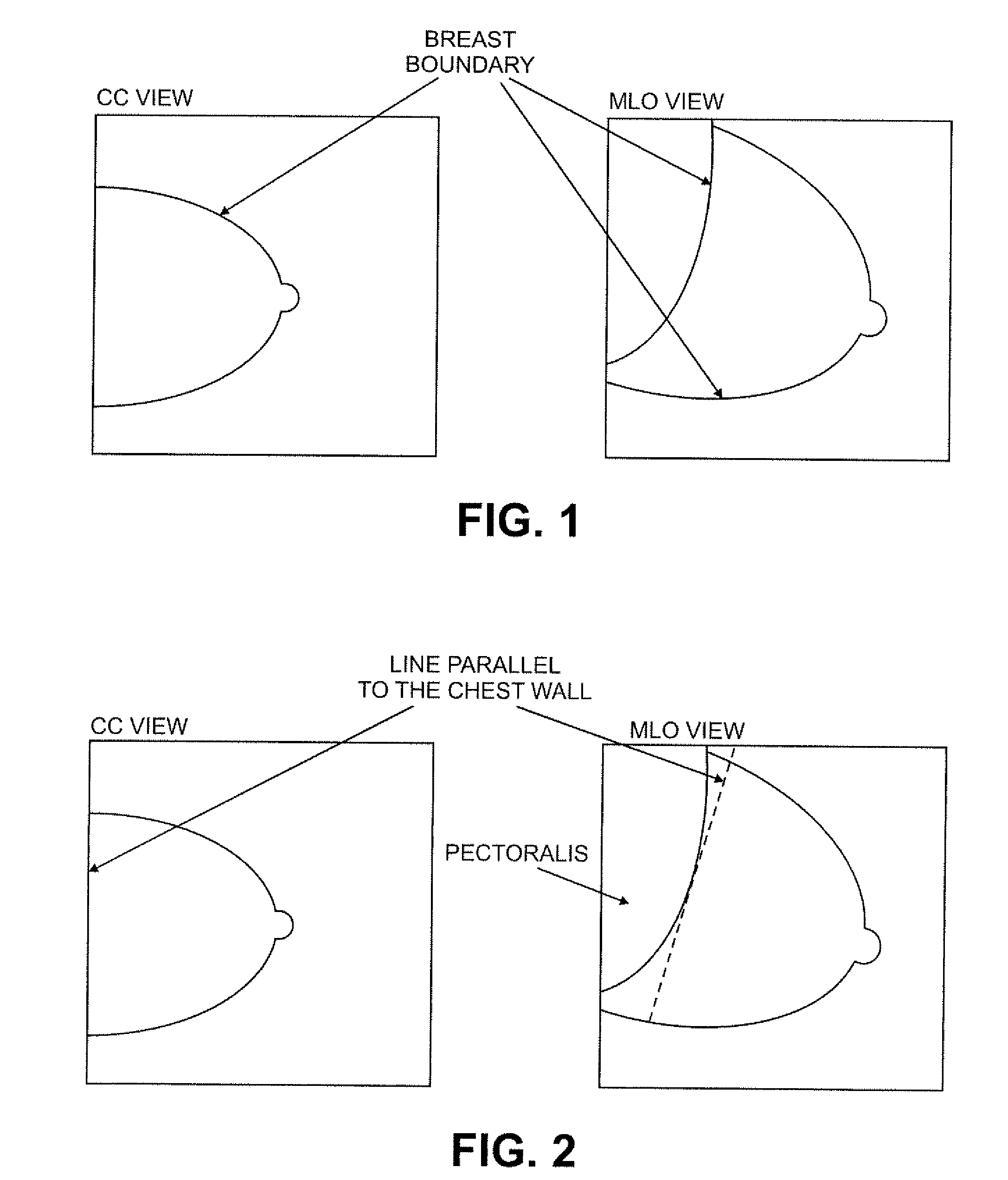 Methods and Apparatus for Computer Automated Diagnosis of Mammogram Images