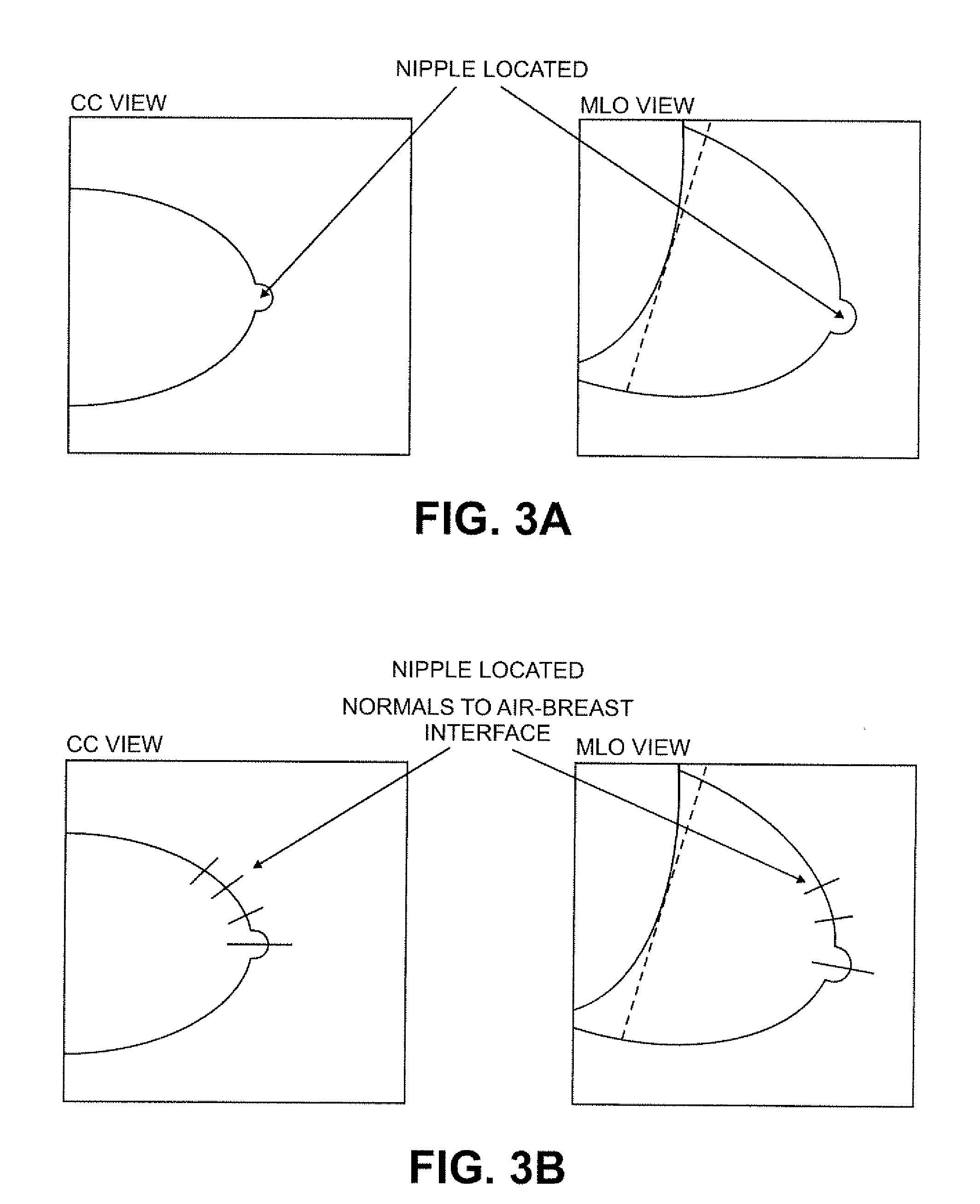 Methods and Apparatus for Computer Automated Diagnosis of Mammogram Images