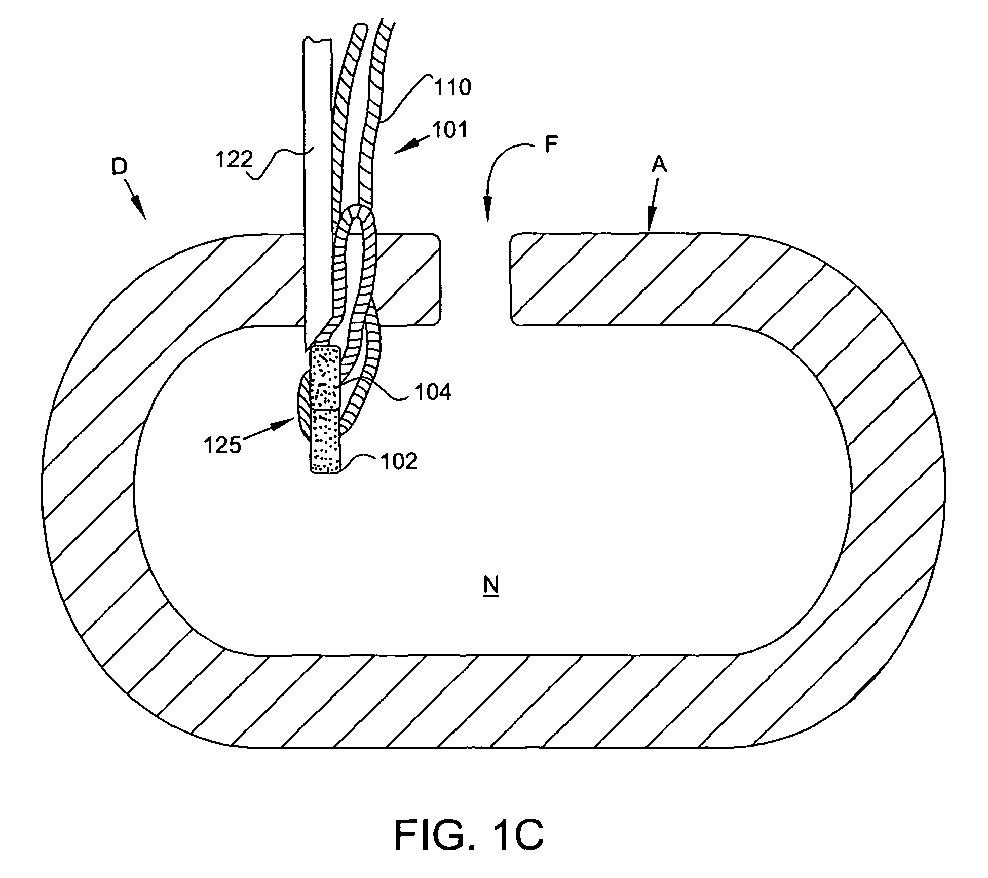 Method and apparatus for closing fissures in the annulus fibrosus