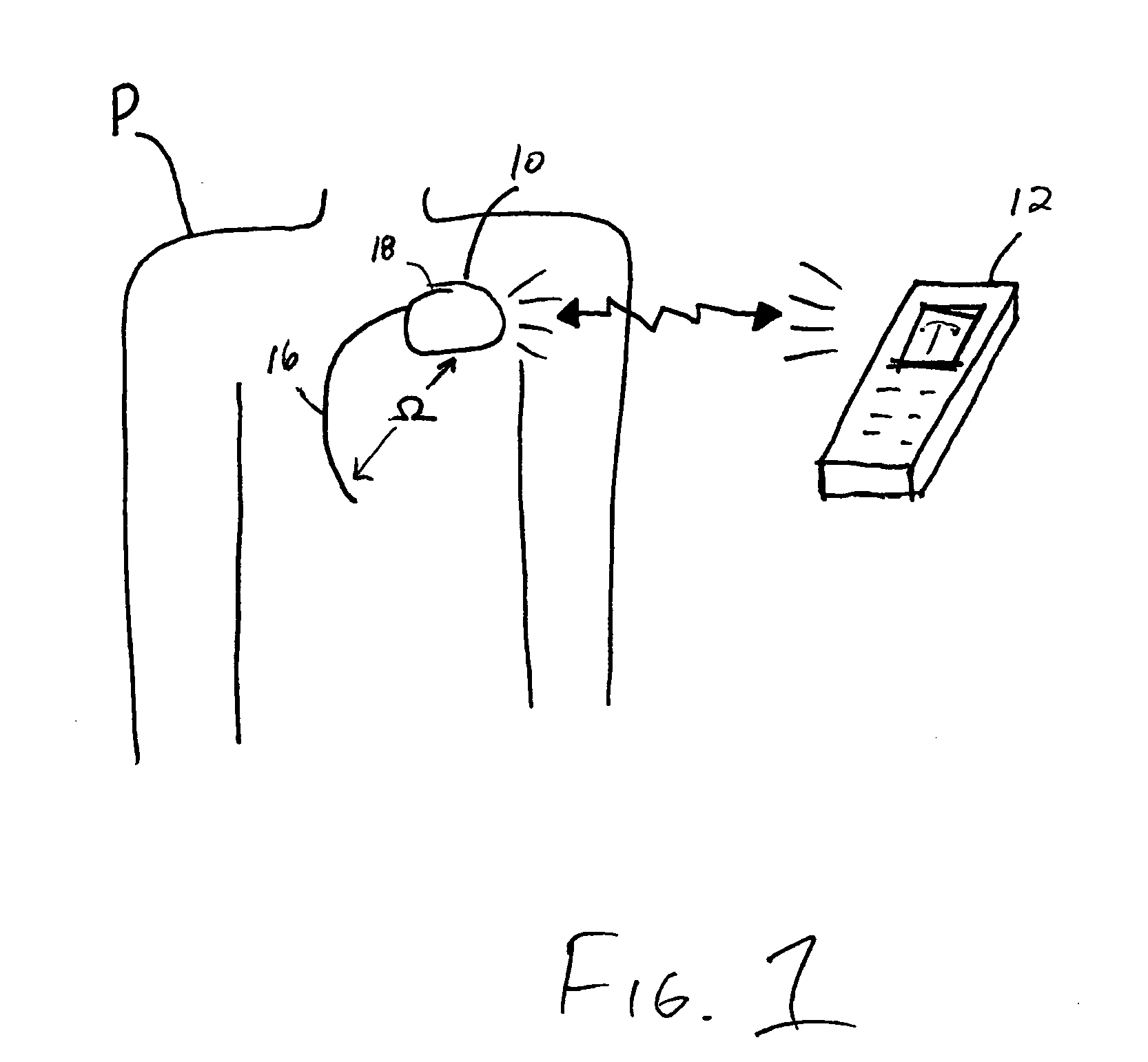 Edema monitoring system and method utilizing an implantable medical device
