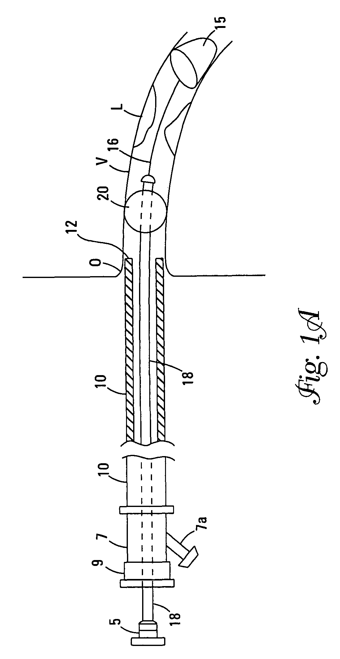 Catheter with occluding cuff