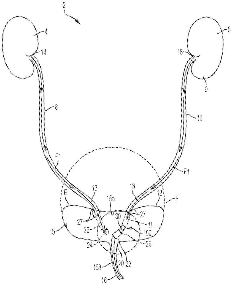 Pump assembly and system for inducing negative pressure in portion of urinary tract of patient