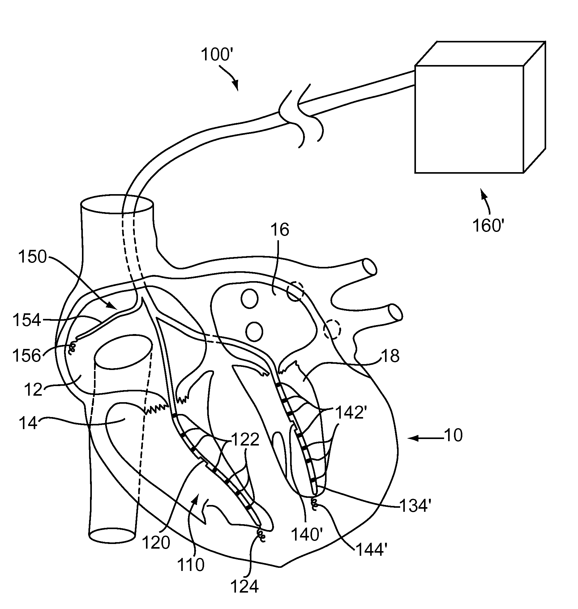 Cardiac pacemakers and systems and methods for using them