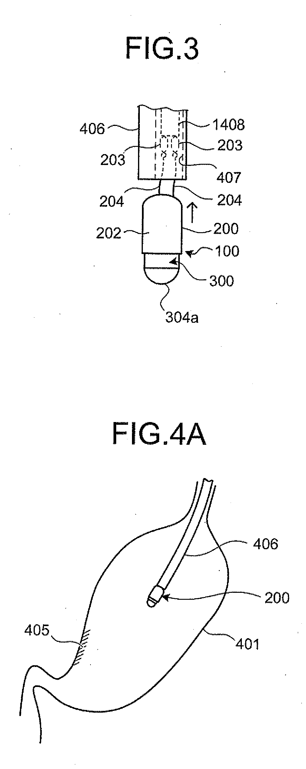 Indwelling device for encapsulated medical device, in-vivo indwelling device for capsule endoscope, and capsule-indwelling medical device