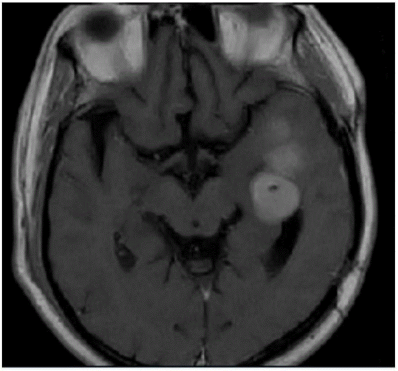 Lesion volume measurement based MRI (Magnetic Resonance Imaging) automatic image segmentation method