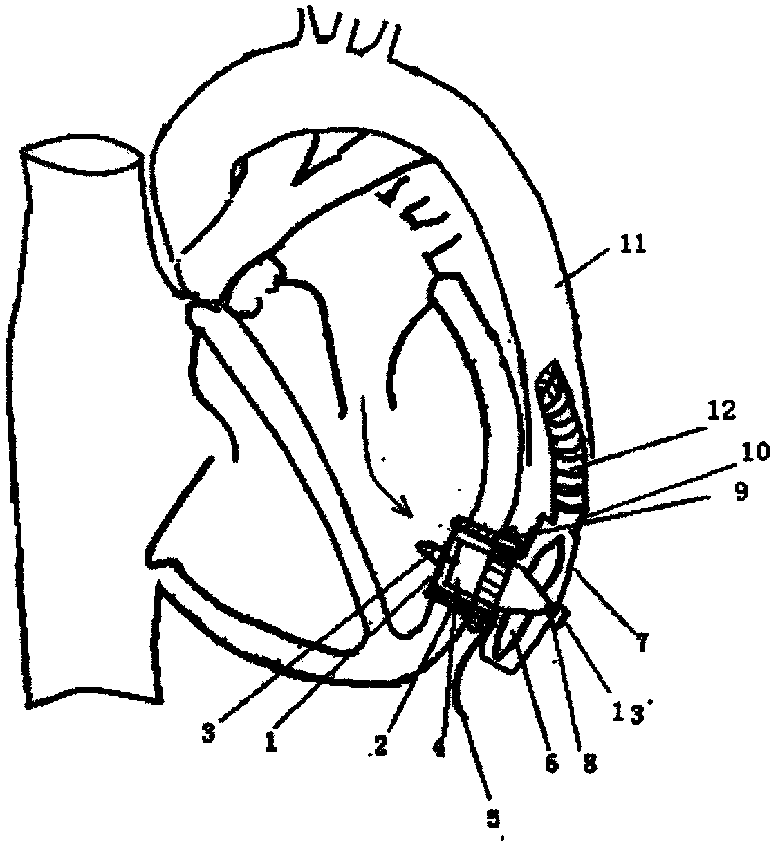 Ultrasonic anti-thrombus magnetic suspension cardiac apex centrifugal pump