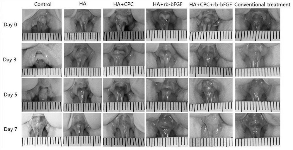 Soluble drug-loaded microneedle patch for treating recurrent aphthous ulcer as well as preparation method and application of soluble drug-loaded microneedle patch