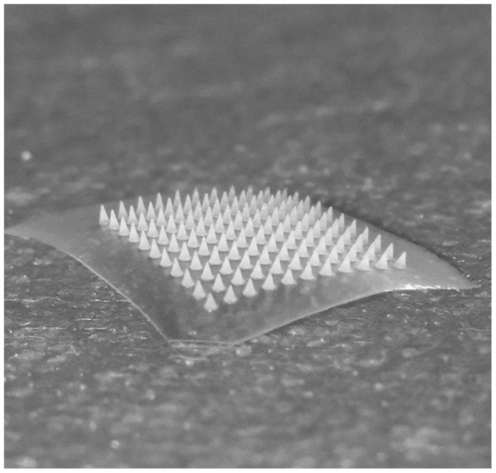 Soluble drug-loaded microneedle patch for treating recurrent aphthous ulcer as well as preparation method and application of soluble drug-loaded microneedle patch