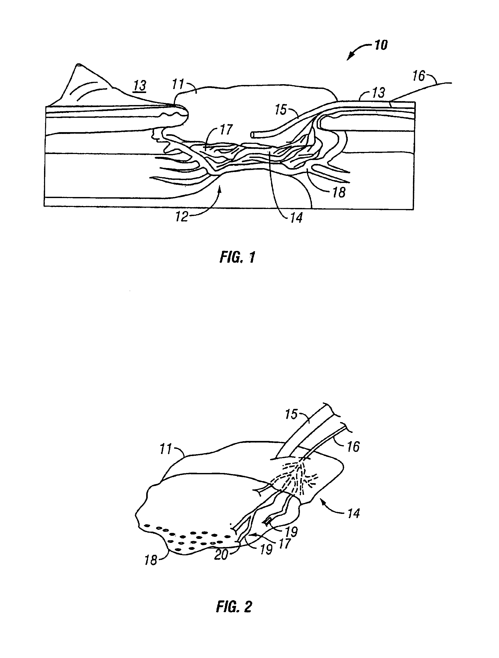 Vacuum assisted closure pad with adaptation for phototherapy