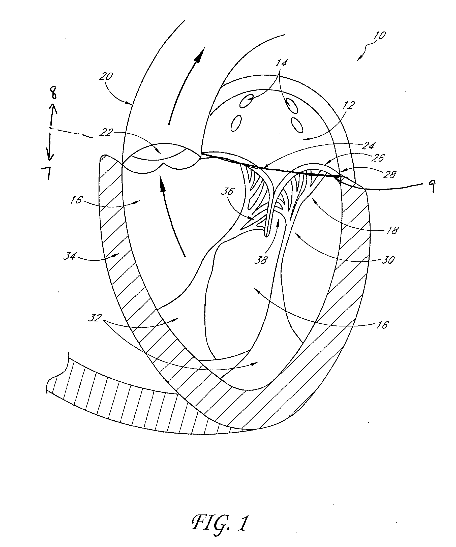 Transvalvular intraannular band and chordae cutting for ischemic and dilated cardiomyopathy