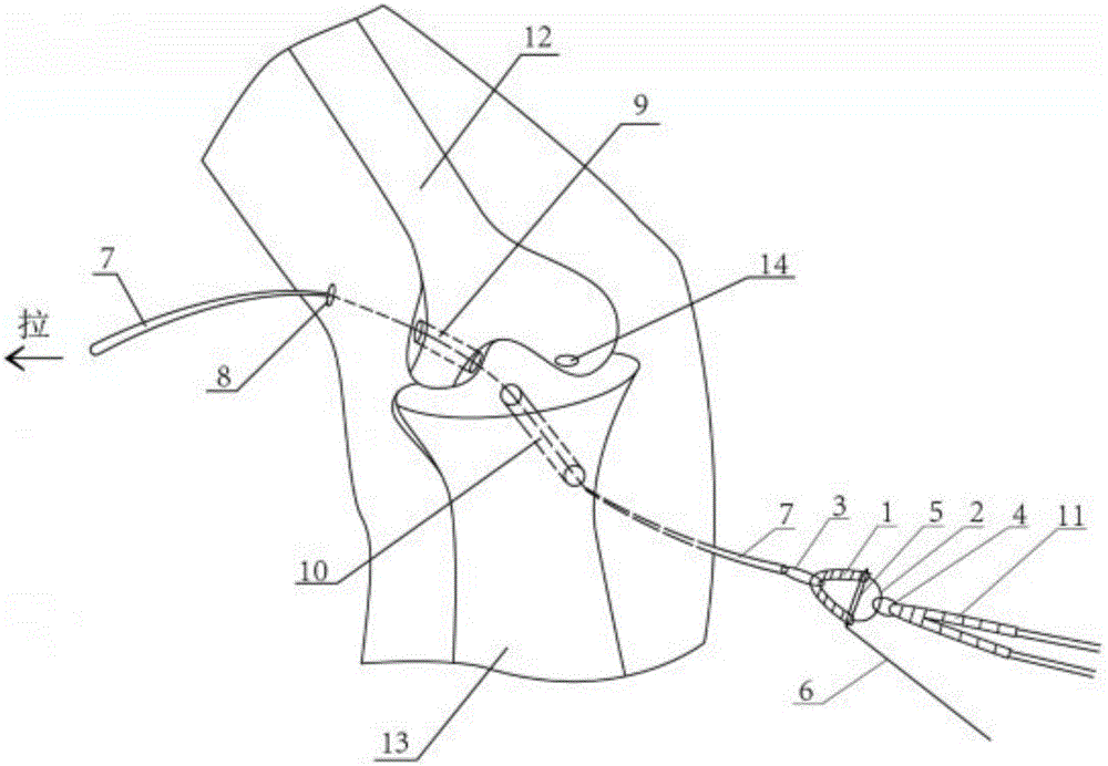 Paraglider-shaped fixed plate device for cruciate ligament reconstruction