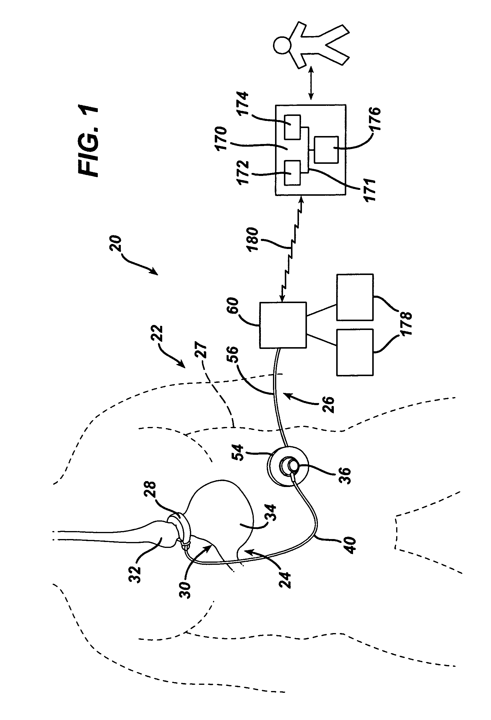 Data Analysis for an Implantable Restriction Device and a Data Logger