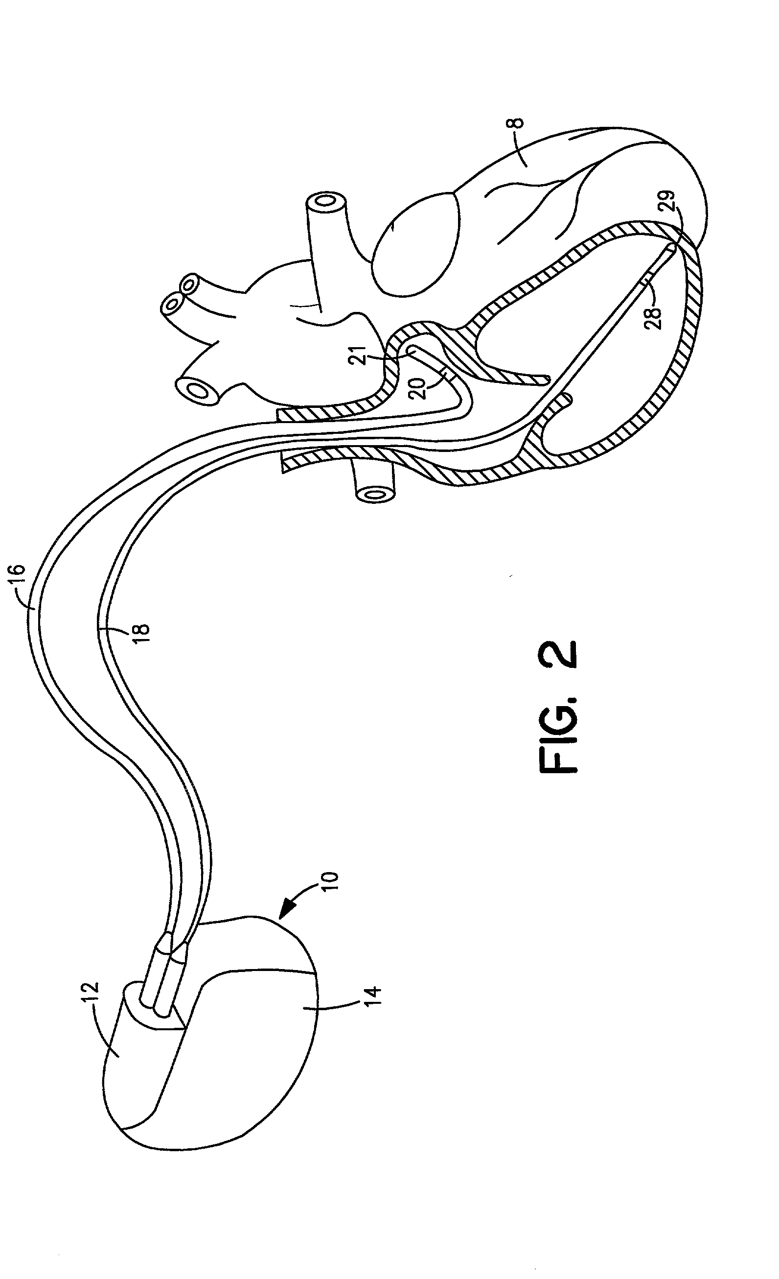 Method and system for atrial capture detection based on far-field R-wave sensing