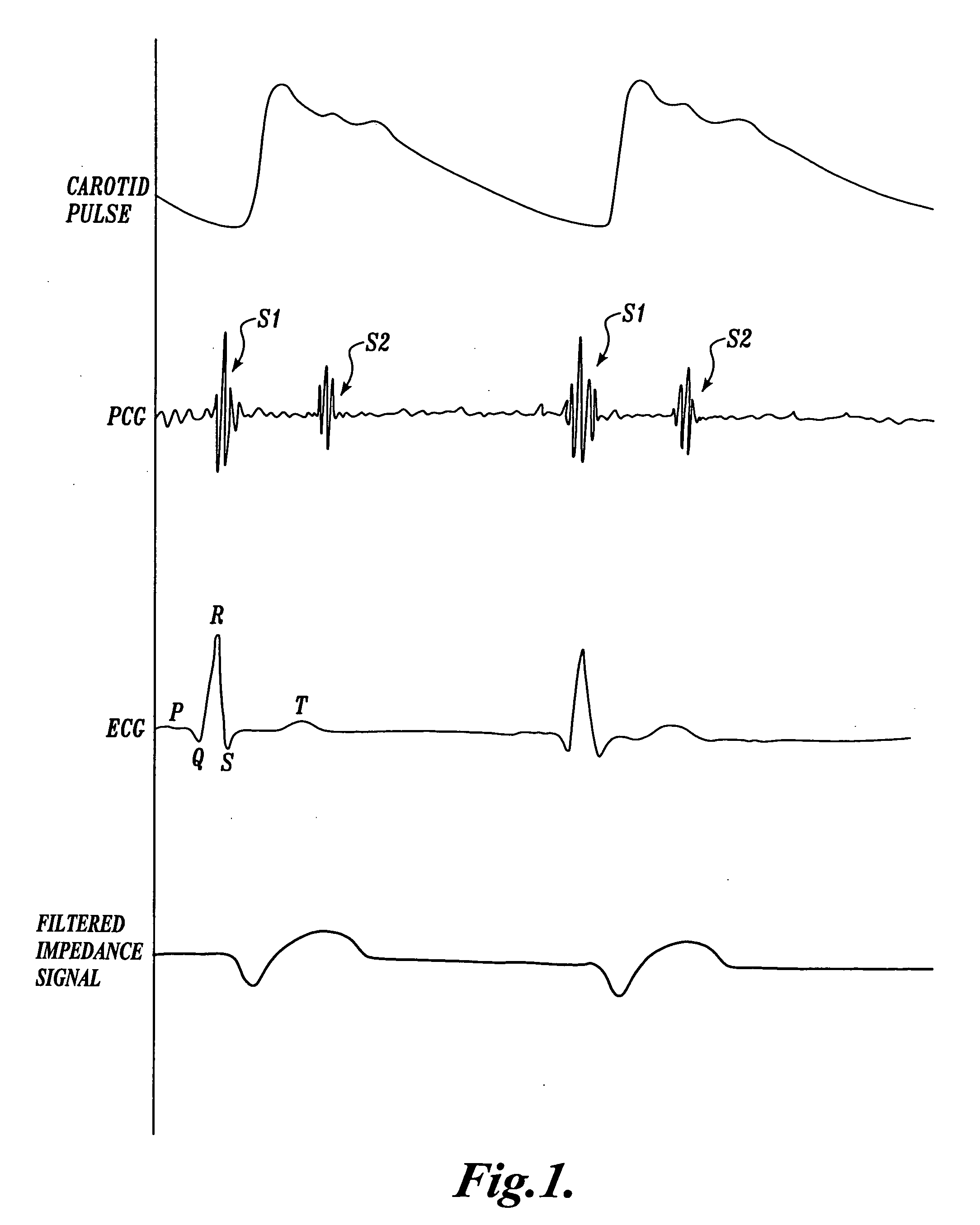 Pulse detection apparatus, software, and methods using patient physiological signals