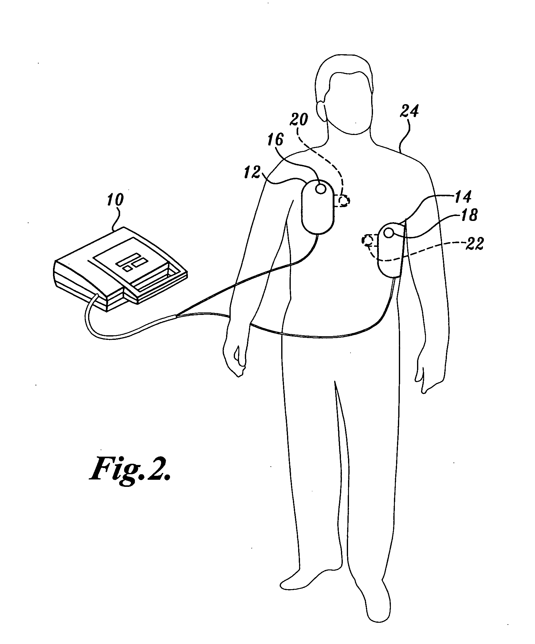 Pulse detection apparatus, software, and methods using patient physiological signals