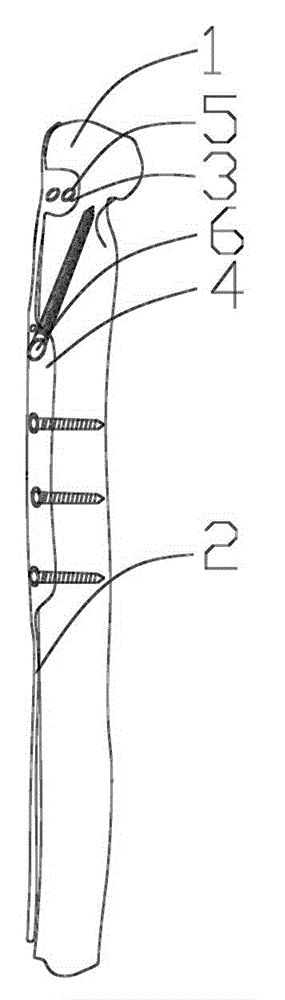 Humeral far-end posterior-lateral double-column fixing and locking bone fixation plate