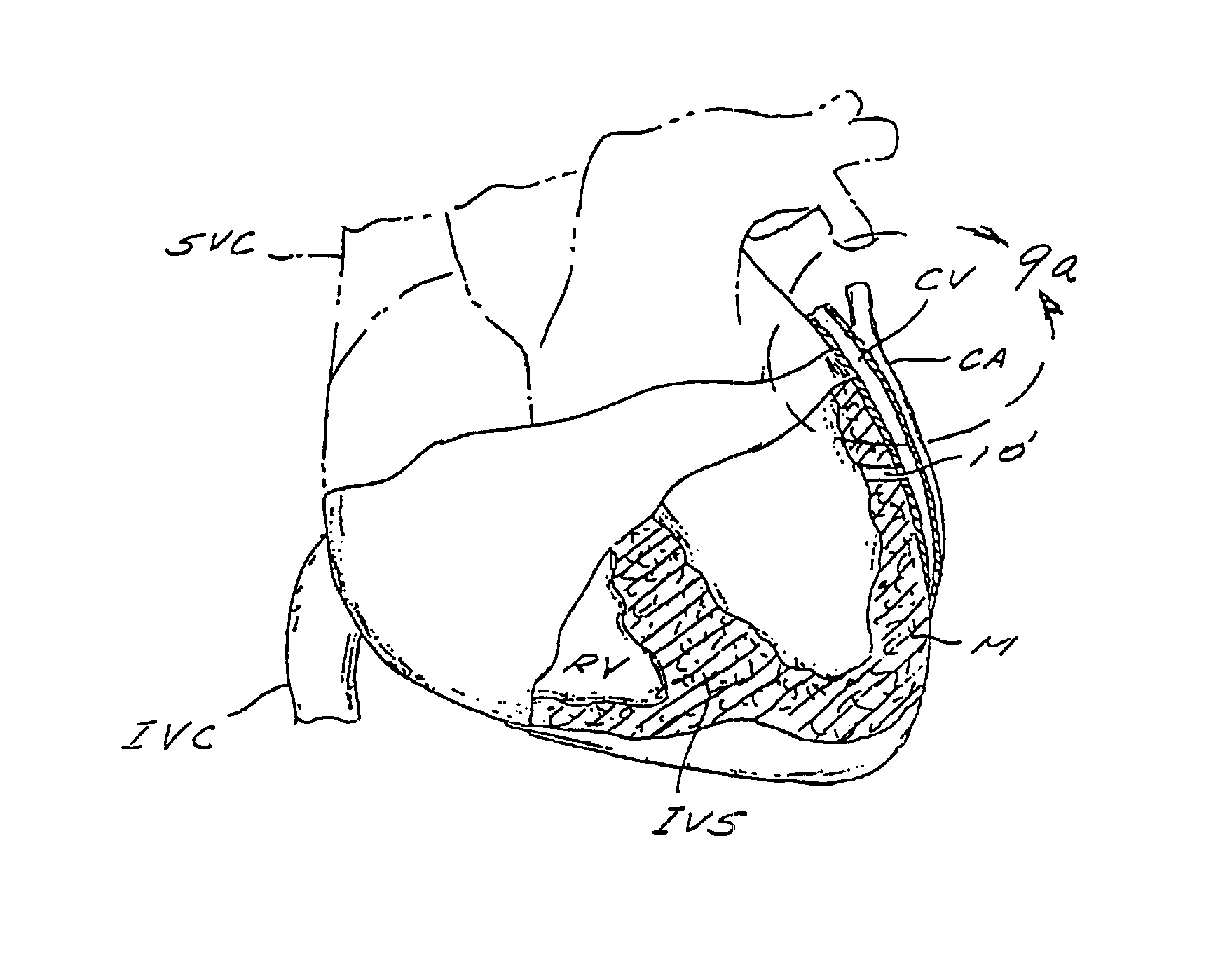 Method and apparatus for transmyocardial direct coronary revascularization