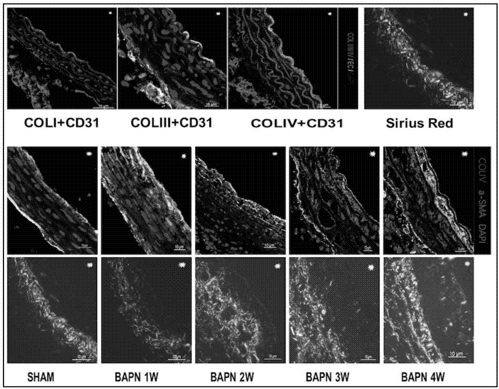 Application of tetratype collagen serving as target spot in early-diagnosis of aortic aneurysm/interlayer