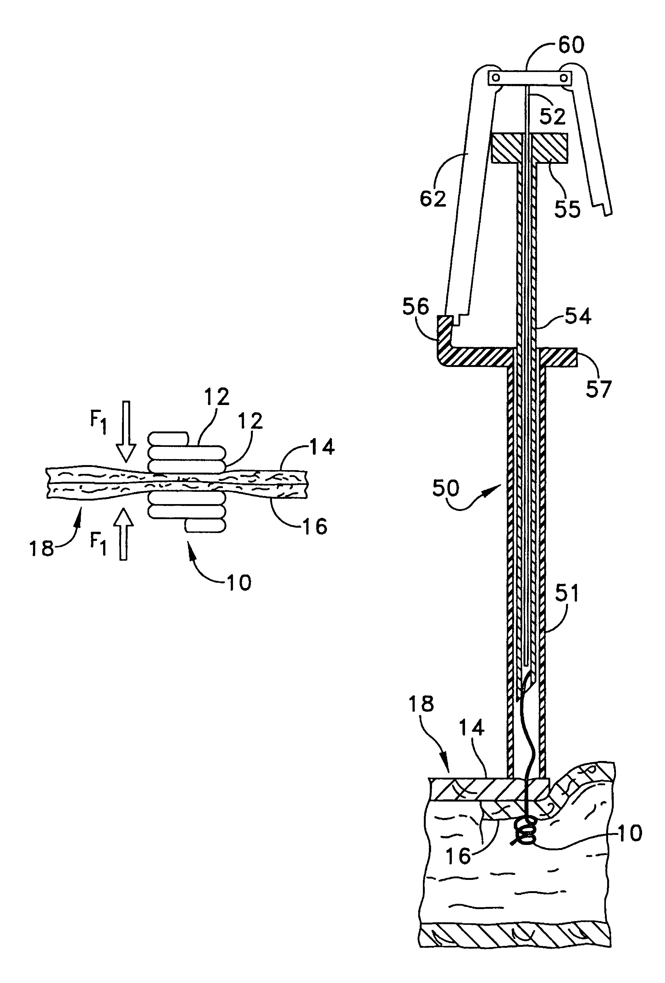 Multi-fastener surgical apparatus and method