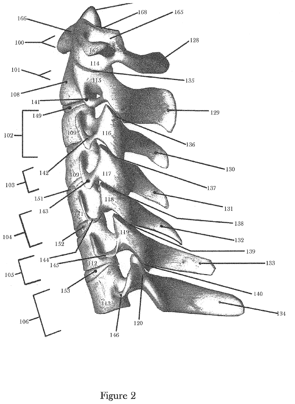 Minimally intrusive cervicothoracic laminoplasty system