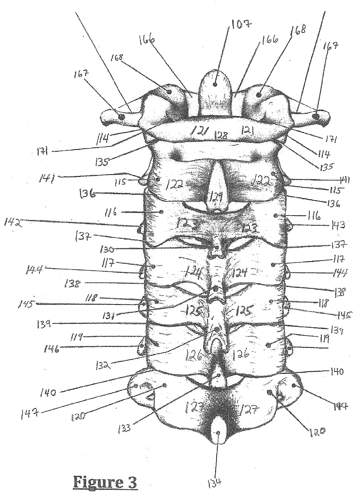 Minimally intrusive cervicothoracic laminoplasty system