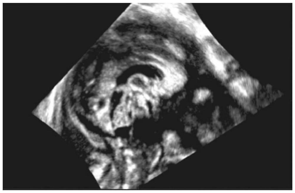 Method for positioning and segmenting cerebellar earthworms in ultrasonic image