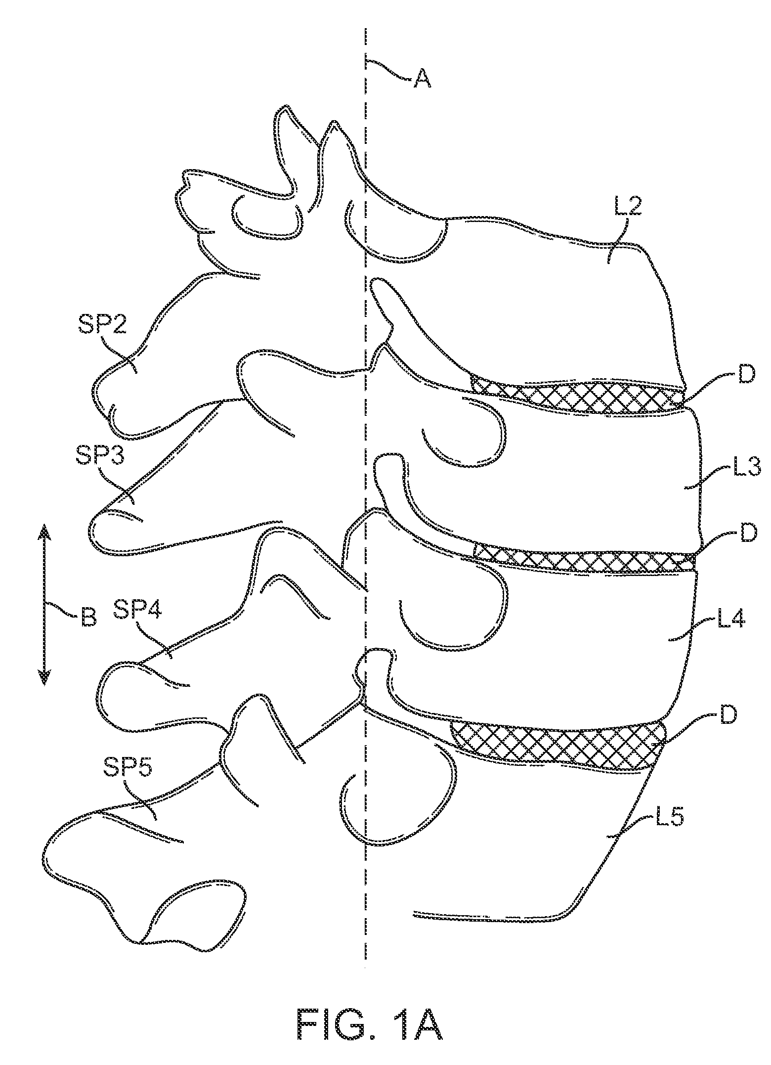 Methods and systems for increasing the bending stiffness and constraining the spreading of a spinal segment
