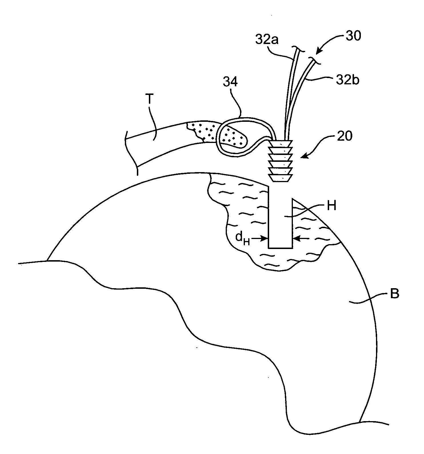 Apparatus and methods for securing tissue to bone