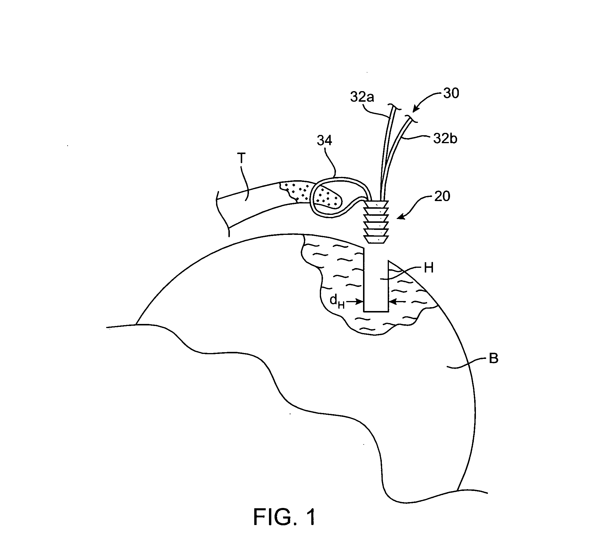 Apparatus and methods for securing tissue to bone