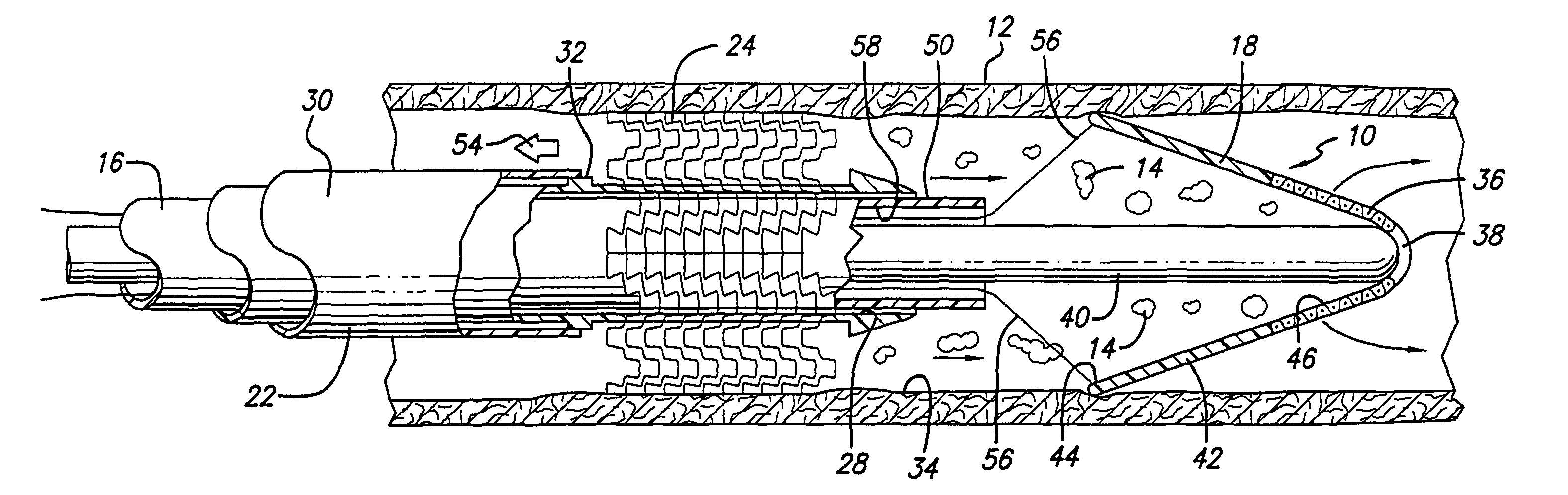 Device for, and method of, blocking emboli in vessels such as blood arteries