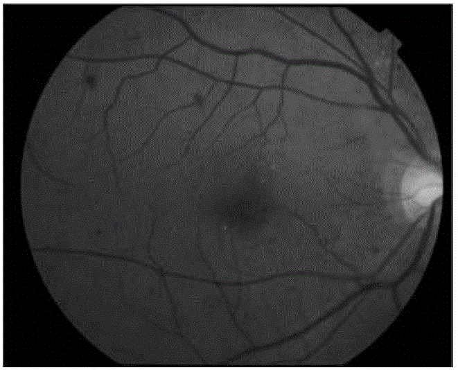 Retinal fundus image bleeding detection method