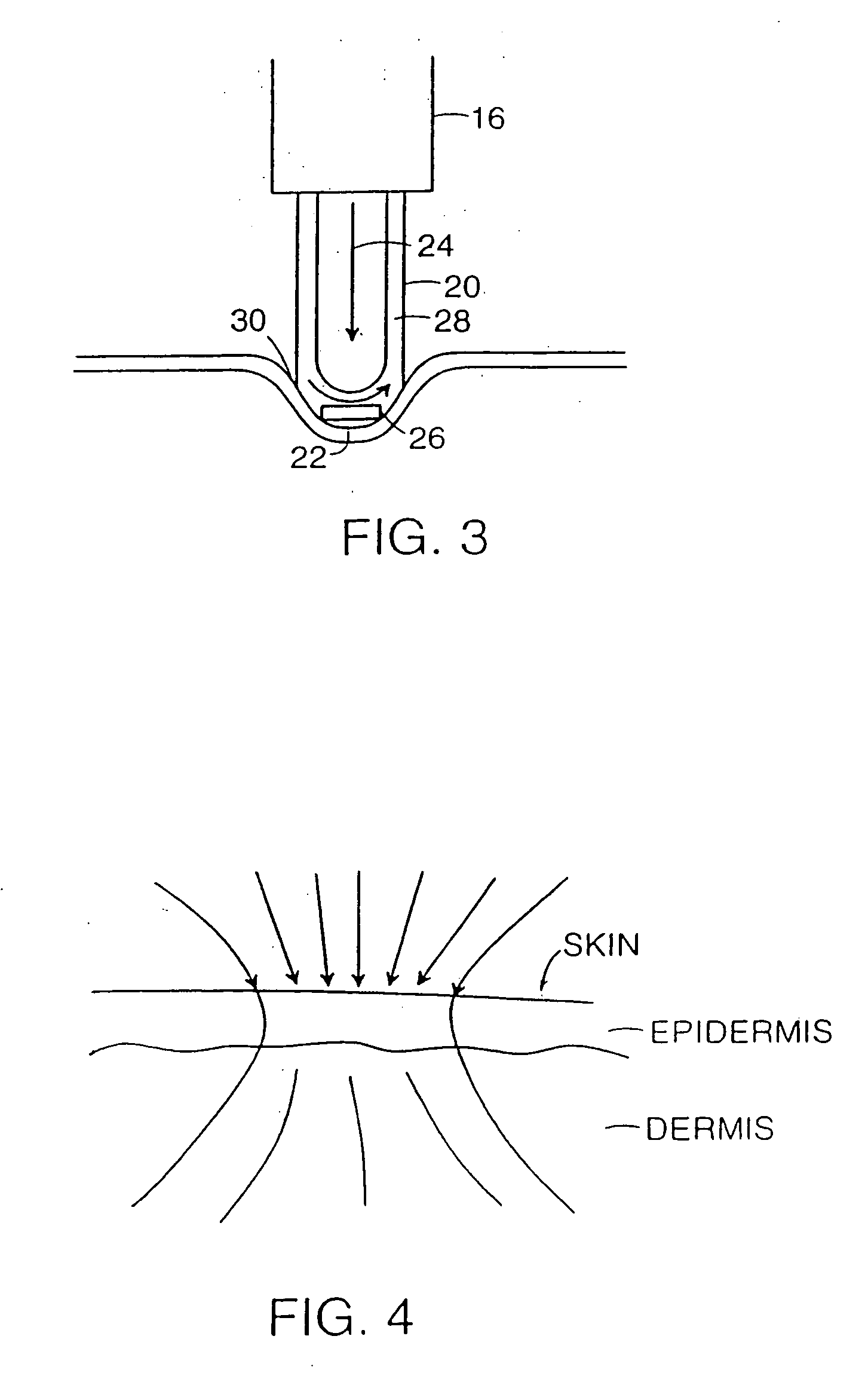 Method and apparatus for treating wrinkles in skin using radiation