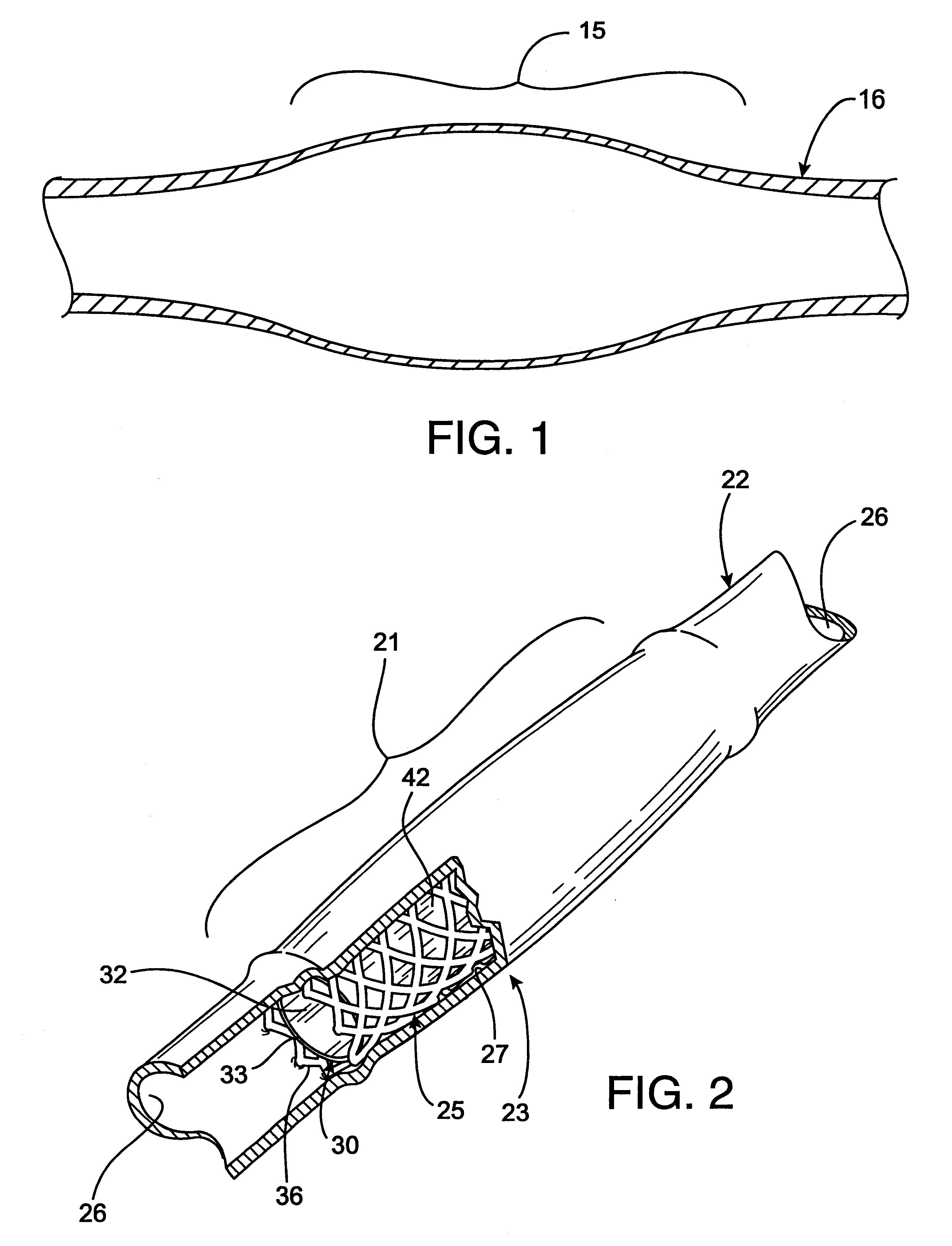 Radioactive intraluminal endovascular prosthesis and method for the treatment of aneurysms