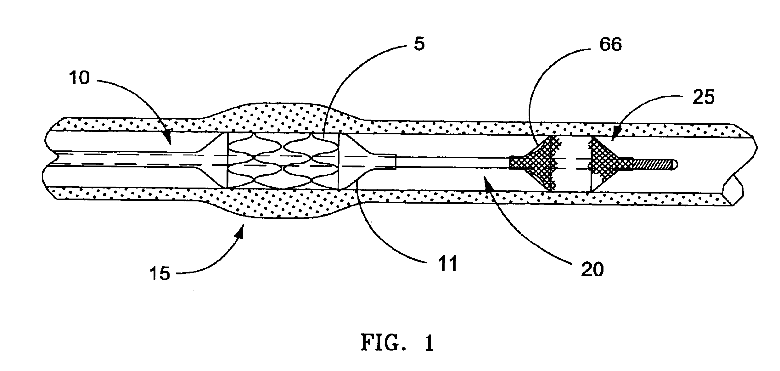 Temporary intraluminal filter guidewire and methods of use