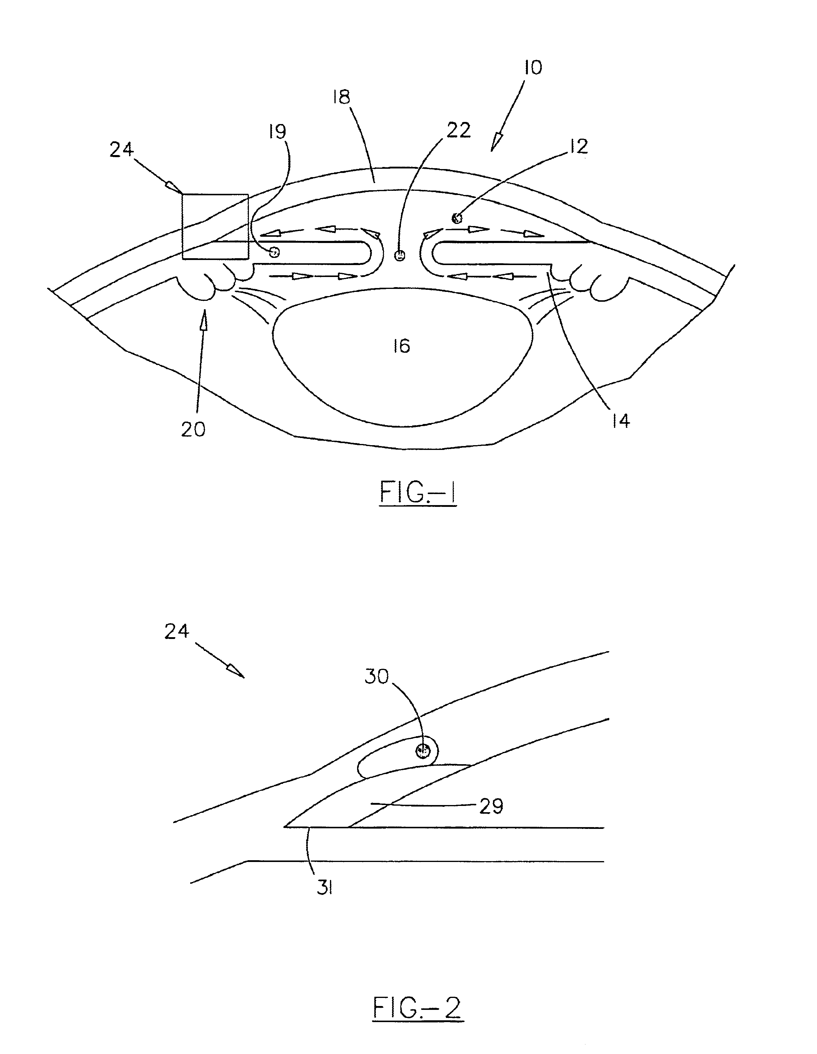Method and apparatus for treatment of glaucoma