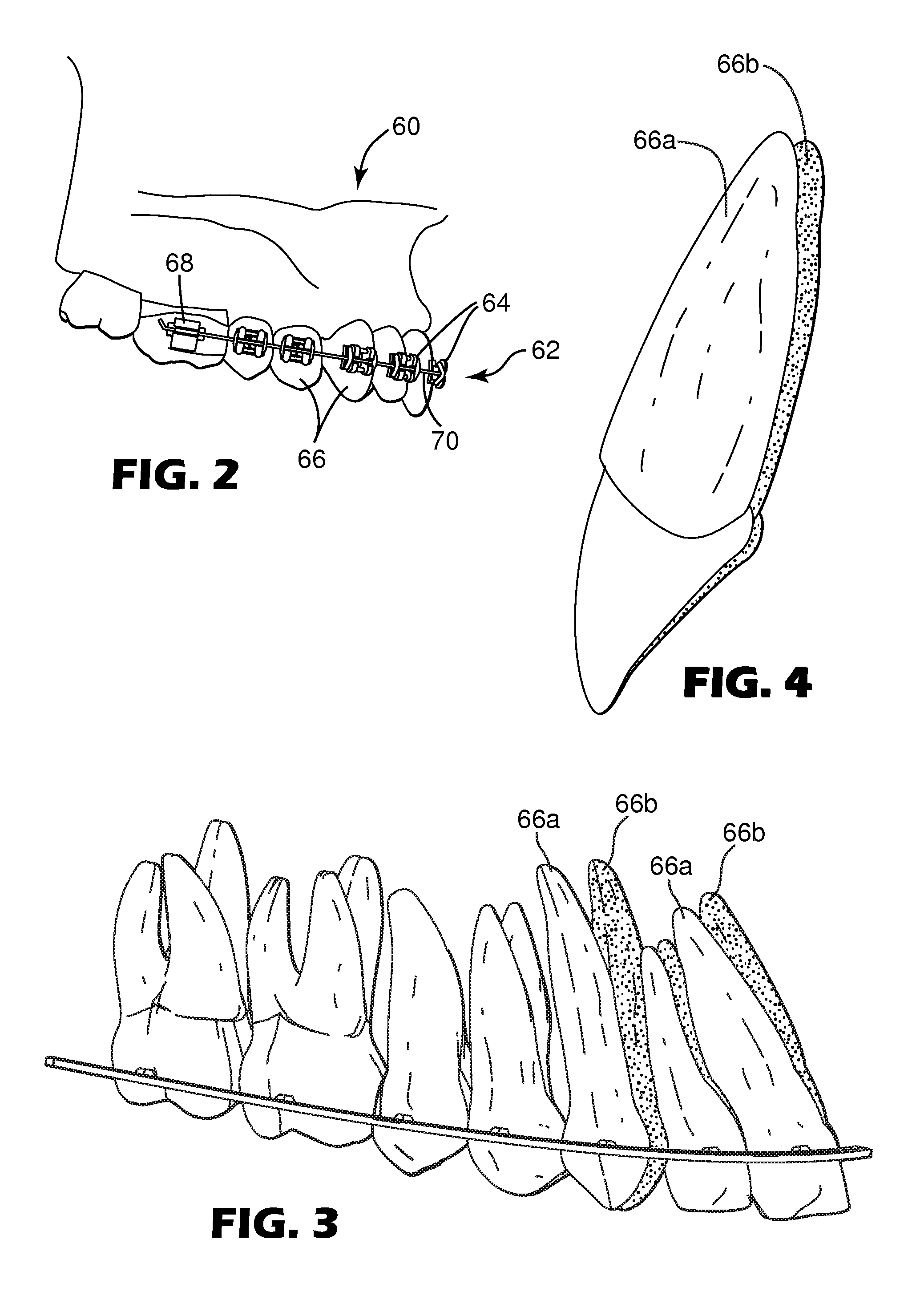 Method and apparatus for selecting a prescription for an orthodontic brace
