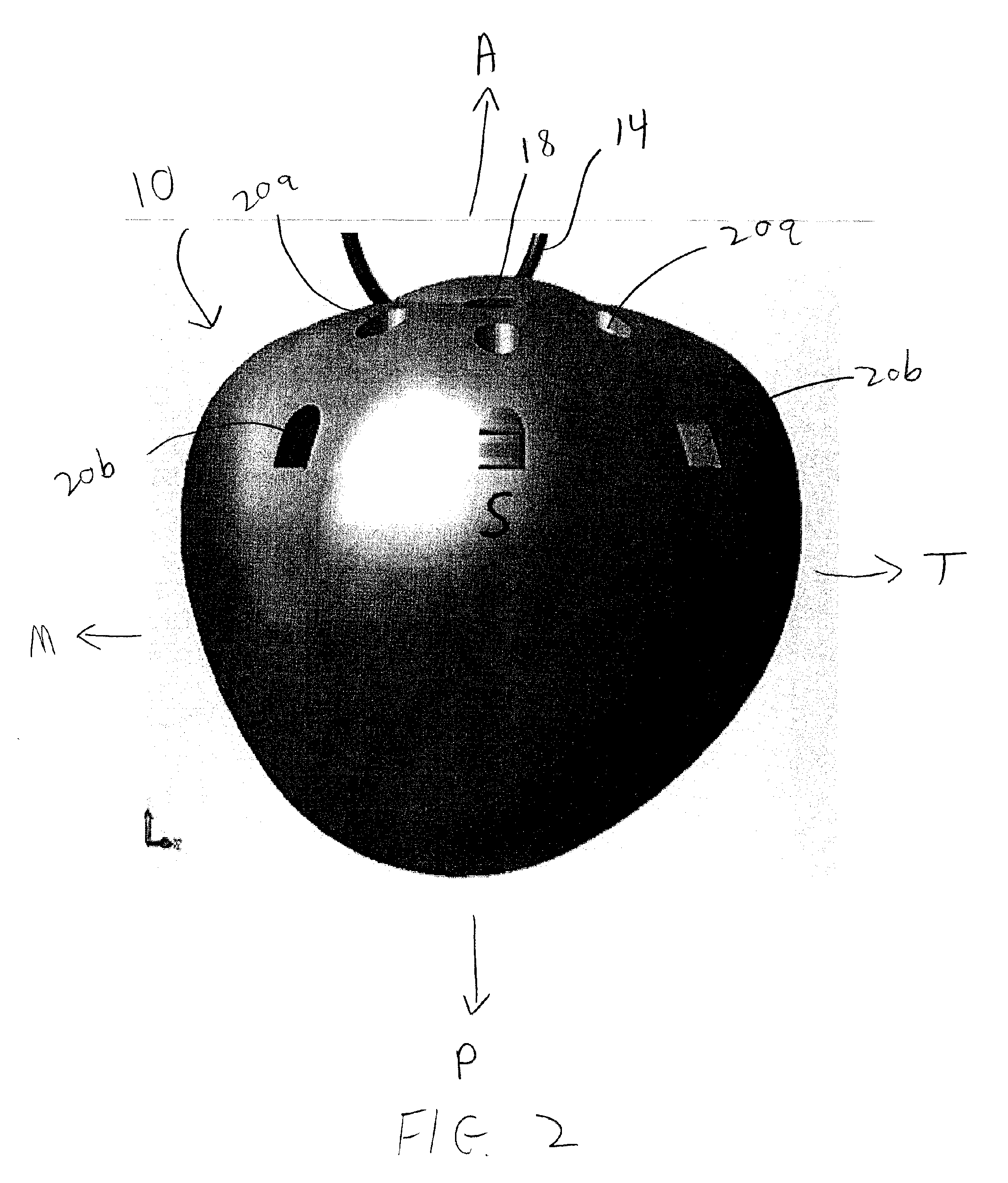 Quasi-spherical orbital implant