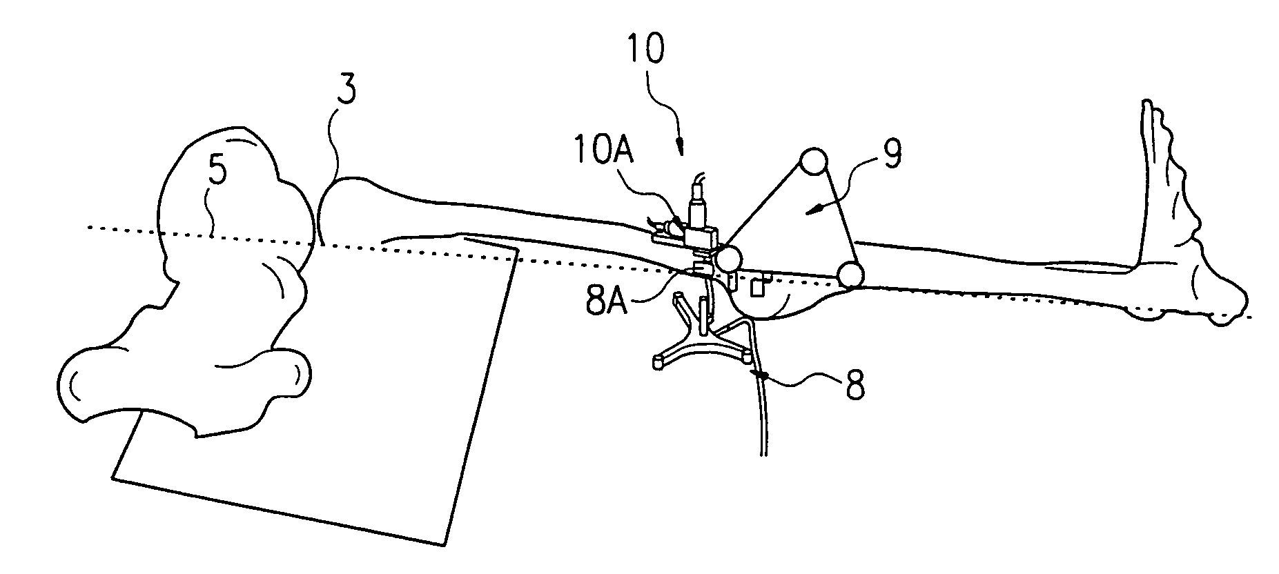 Method and apparatus for finding the position of a mechanical axis of a limb