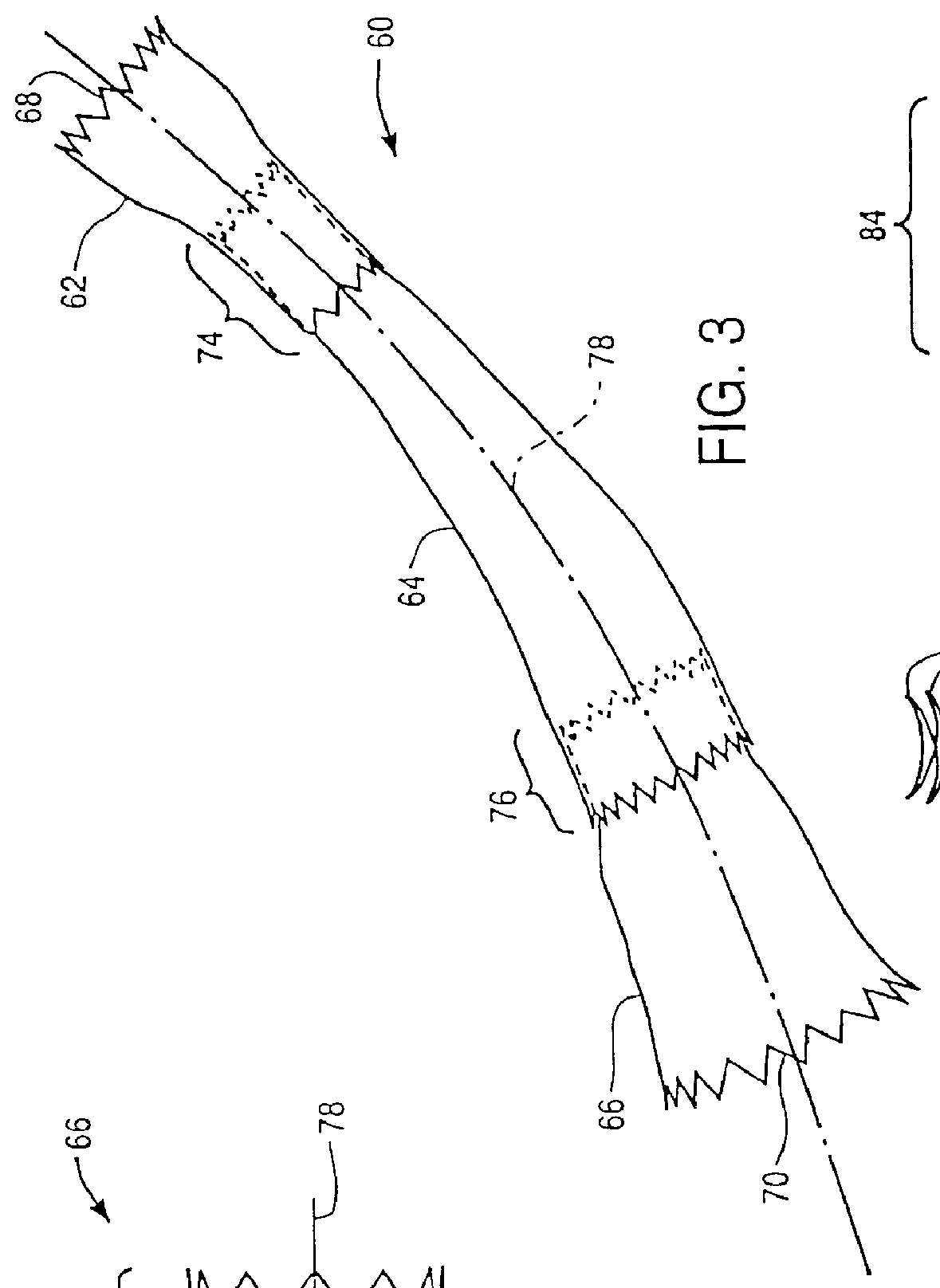 Method for deploying cuff prostheses